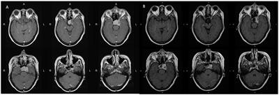 Case report: Ruptured internal carotid artery fusiform aneurysm mimicking pituitary apoplexy after stereotactic radiosurgery